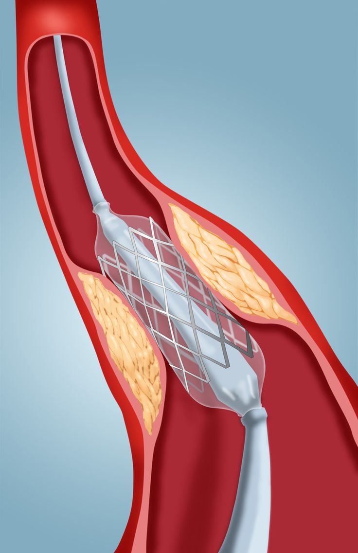 Angioplasty kya hai? Stent kaise lagaya jaata hai? (What is Angioplasty? Procedure Explained)
