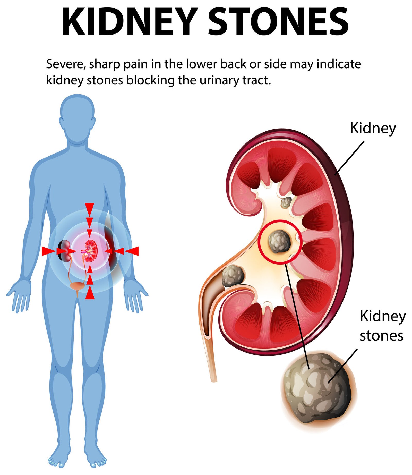 Kidney Stone (Gurde ki Pathri) - Karan, Lakshan aur Ilaj